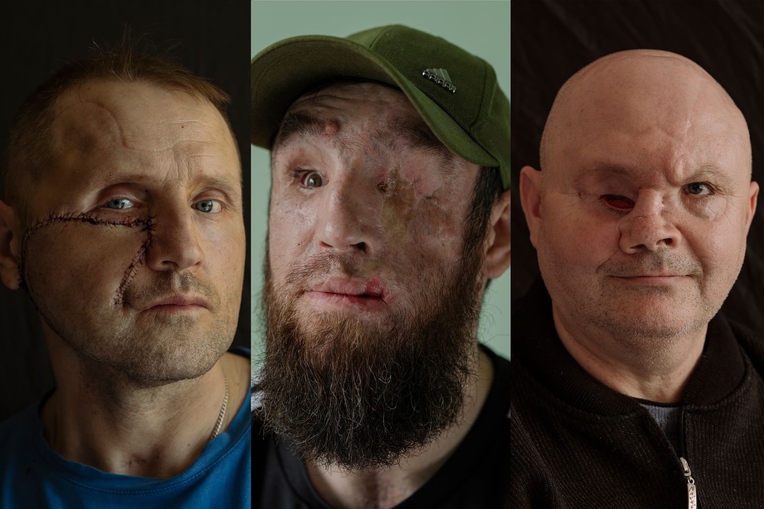 'I didn’t recognize myself' — For Ukrainian soldiers with facial wounds, US surgeons help restore dignity